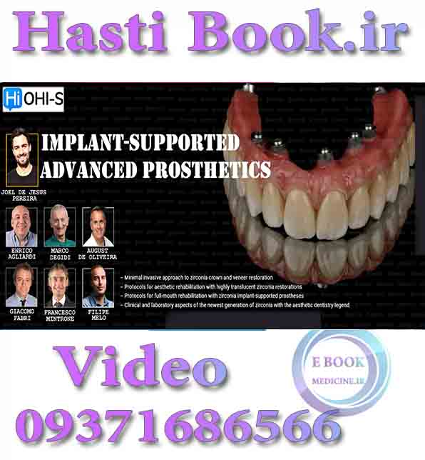 فیلم OHI-S Implant-Supported Advanced Prosthesis Video