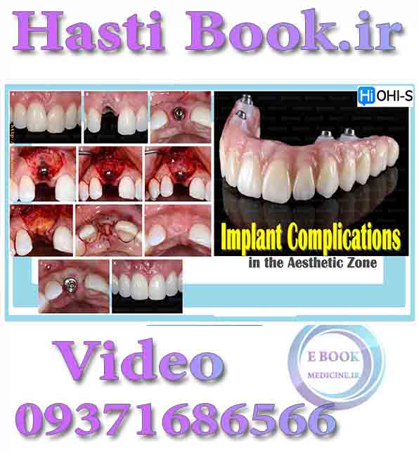 فیلم OHI-S Implant Complications in the Aesthetic Zone video