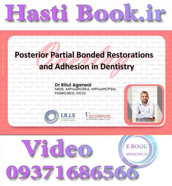 فیلم IRIS Posterior Partial Bonded Restorations and Adhesion in Dentistry (Overlay) - Ritul Agarwal video