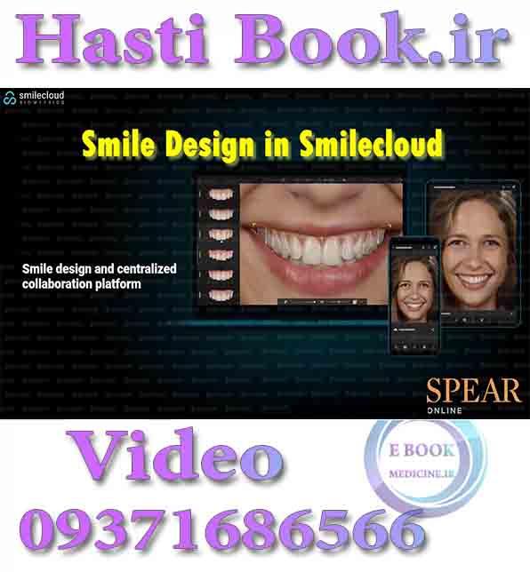 فیلم Spear Smile Design in Smilecloud video